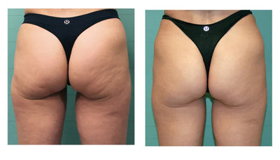 exelis buttocks cellulite before after 1 700x 700x 724c4d6d 7c54 4e4f 82d6